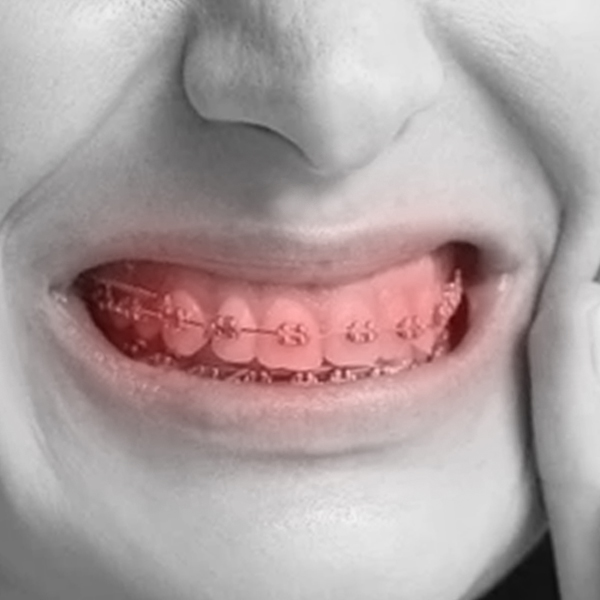 Orasore-Dental-Tablet-Dental-Braces
